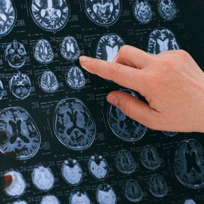 Médico analisando exame de imagem cerebral, ilustrando o sistema endocanabinoide e sua ação no cérebro